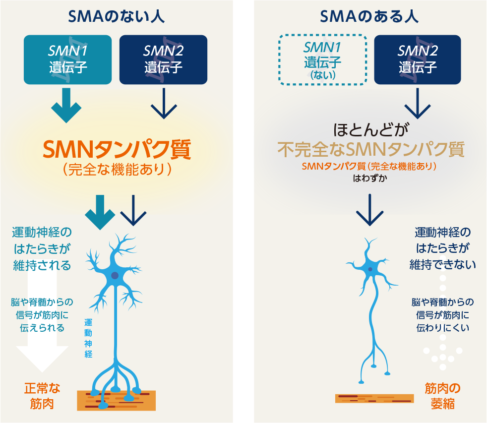 SMAの原因