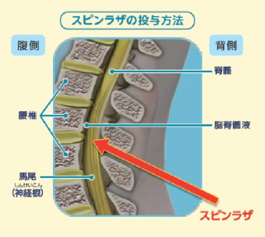 スピンラザの投与方法